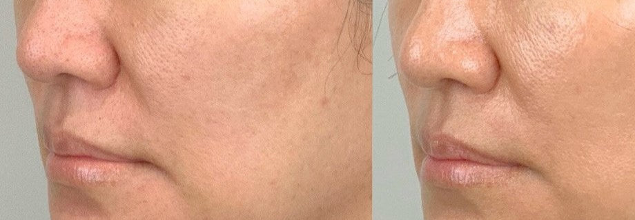 Before and after comparison of skin treatment with PDRN Salmon DNA, showing a person's face.
