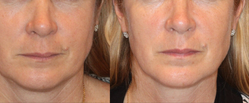 Side-by-side comparison of a woman's face before and after a procedure.