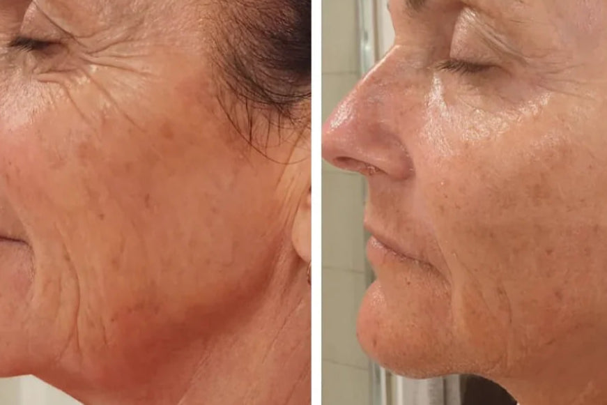 Before and after comparison of a woman's face with visible skin treatment results.