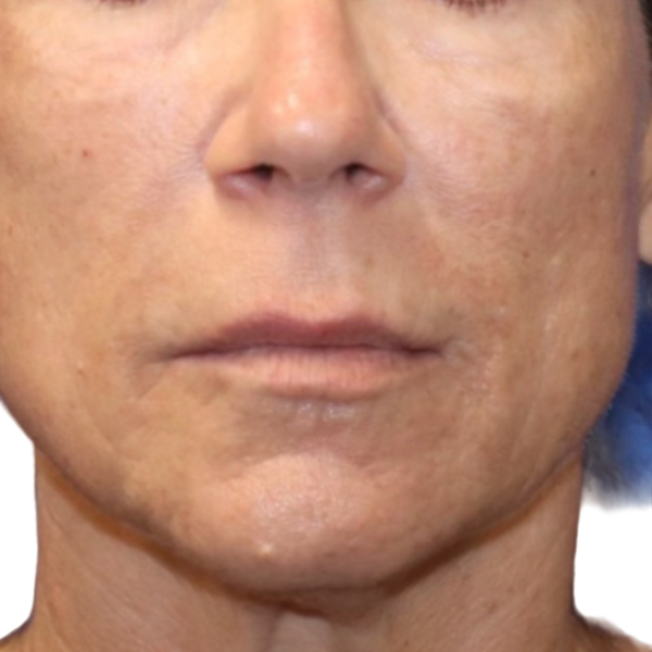 Close-up of a person's face with visible skin texture and pores.